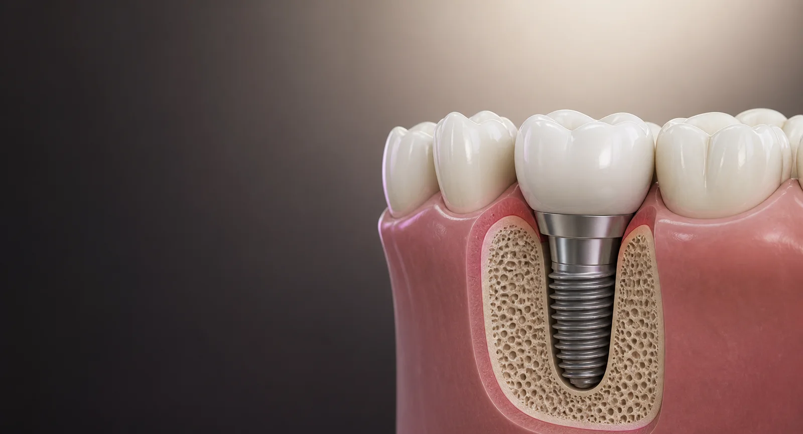 Çene kemiği içinde implant, abutment ve seramik kuronu gösteren temsili tıbbi görsel